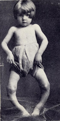 A young child with rickets